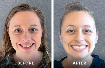 Invisalign clear aligners before and after